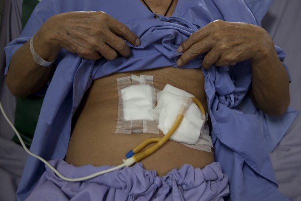 PEG Tube Insertion The Surgery Dr Karanu Ndagitari